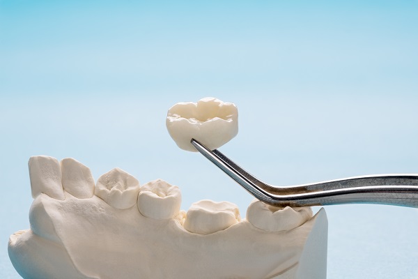 The Average Longevity Of Dental Crowns